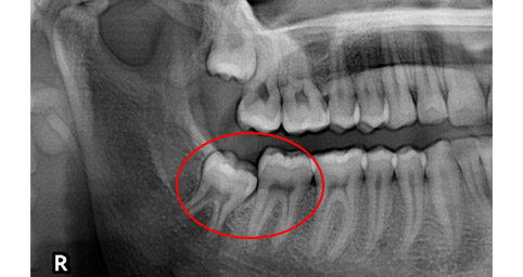 Wisdom teeth extraction image