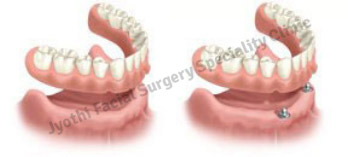 Dental Implants