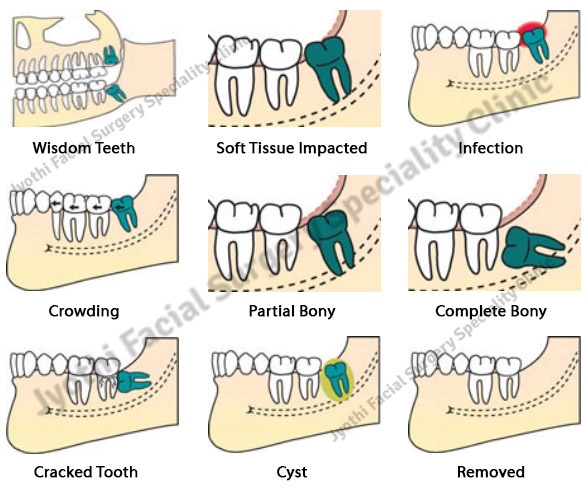 fully-bony-impaction-sherway-gardens-dental-centre